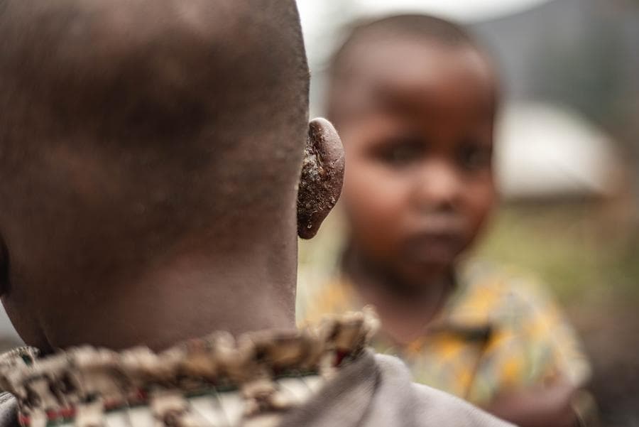 ยอดผู้ป่วย 'เอ็มพอกซ์' ในแอฟริกาใกล้แตะ 30,000 รายแล้ว