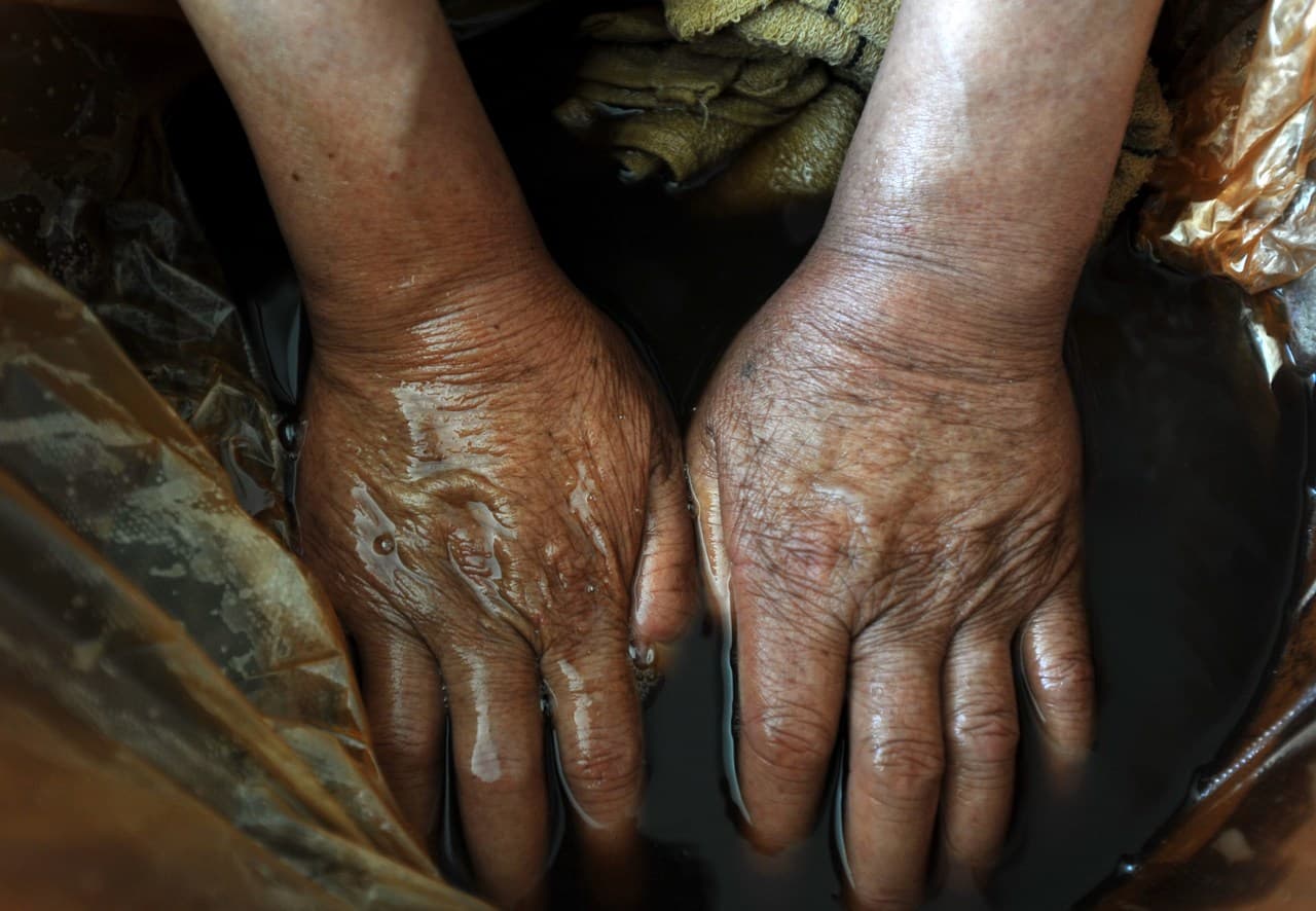 นักวิจัยจีนพัฒนา 'ไฮโดรเจลแบบใหม่' บรรเทาโรคข้ออักเสบรูมาตอยด์